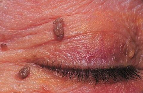 Papilomi na koži vek, ki zahtevajo zdravljenje