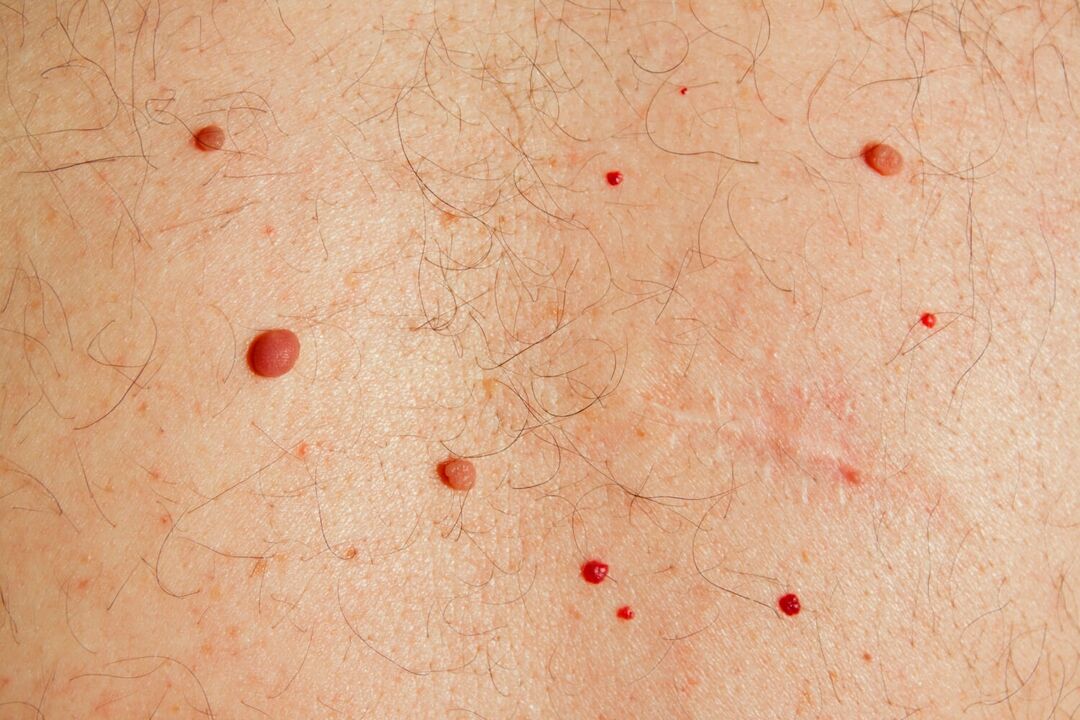 Papilomi na telesu, ki jih povzroča HPV