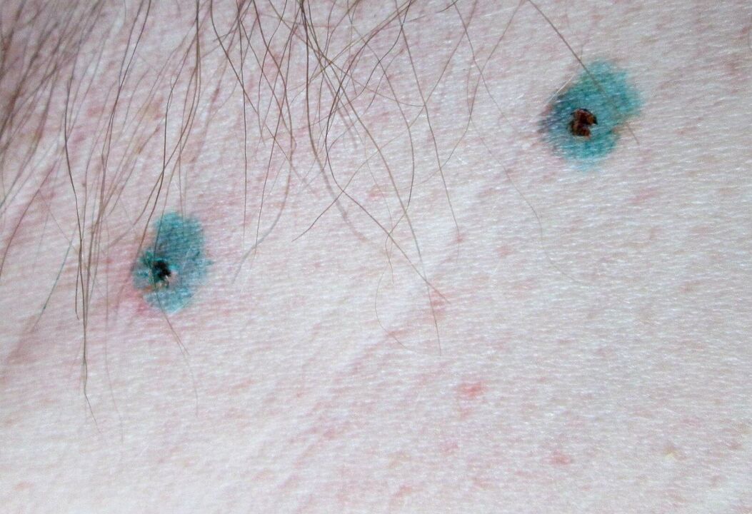 Znamenja na koži po laserskem odstranjevanju papiloma