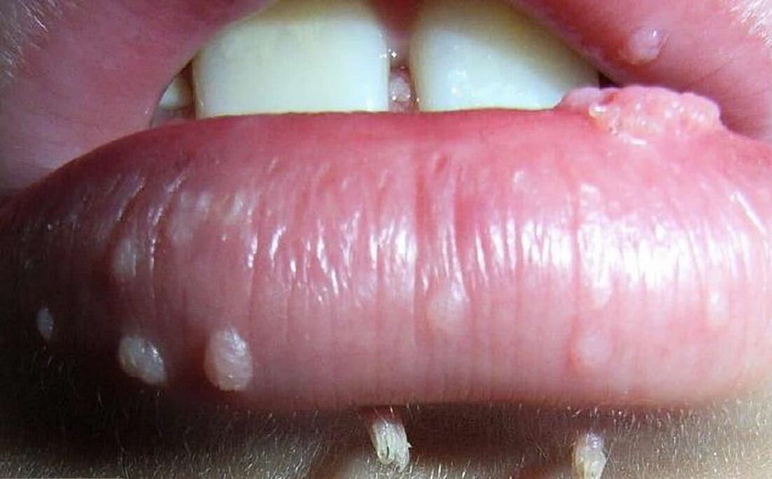 Papilomi na ustnicah